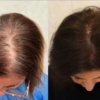alopecia-femminile