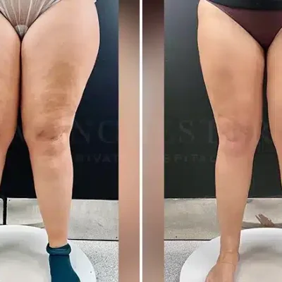 lipedema-liposuction-before-and-after-patient-1-v1
