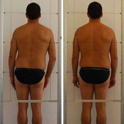 osteopatia_scoliosi