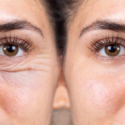peeling-chimico-viso-firenze-dott-ghezzi-1024x654