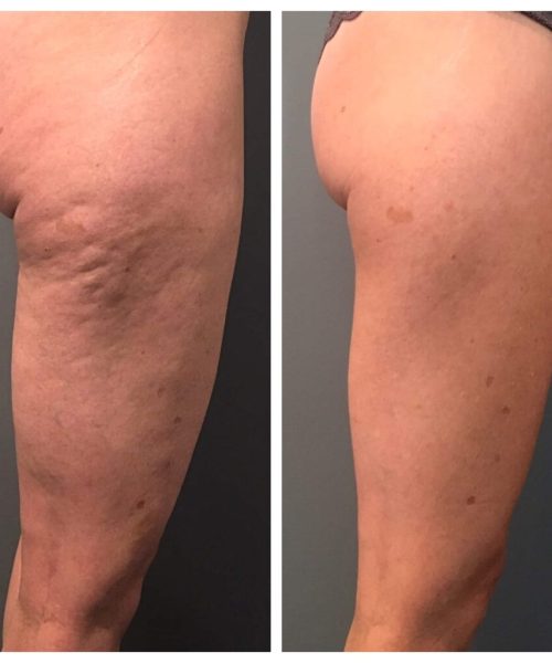 radiofrequenza-cellulite-prima-dopo-1024x1024