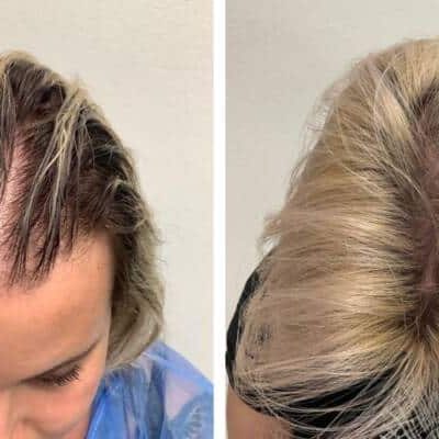 trapianto-capelli-donna-diradata-stempiata-3-800x400
