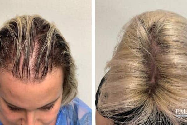 trapianto-capelli-donna-diradata-stempiata-3-800x400